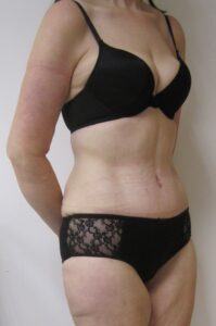 tummy tuck after 5